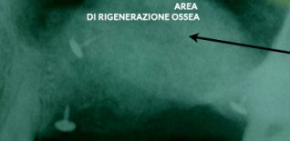 Area di rigenerazione ossea