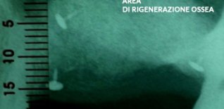 Area di rigenerazione ossea