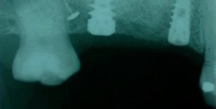 Impianti posizionati