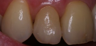 Corona in ceramica su impianto