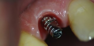 Moncone dell'impianto senza corona