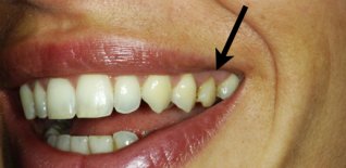 Visione esterna del premolare fratturato