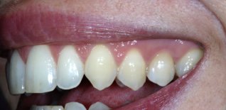 Impianto ed elemento dentario immediato