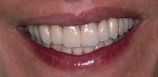 Riabilitazione estetica del sorriso