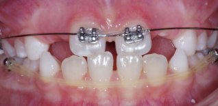 Trattamento di ortodonzia intercettiva