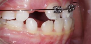 Trattamento di ortodonzia intercettiva