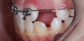 Trattamento di ortodonzia intercettiva