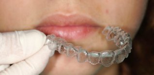 Trattamento ortodontico con mascherine invisibili