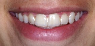 Trattamento ortodontico con mascherine invisibili