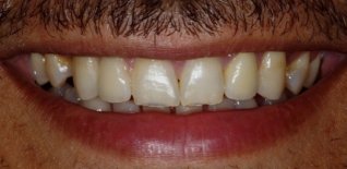 Dopo ortodonzia e impianto del laterale di destra con le ceramiche su entrambi i laterali