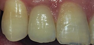 Impianto laterale destro