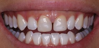 Vecchie ricostruzioni dei 2 centrali