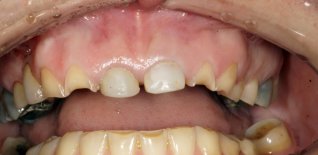 Foto iniziali con forti abrasioni dentali