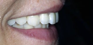 Particolari della riabilitazione estetica