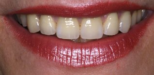 Particolari della riabilitazione estetica