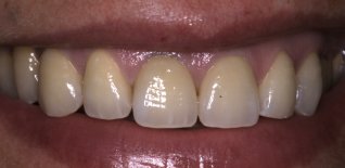 Particolari della riabilitazione estetica