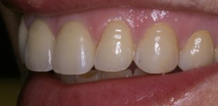 Particolari della riabilitazione estetica