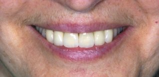 Risultato del trattamento