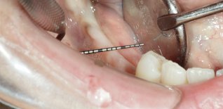 Prima del trattamento