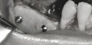 Innesto d'osso in blocco posizionato