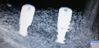 Inserzione degli impianti