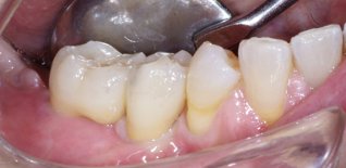 Applicazione degli elementi dentari